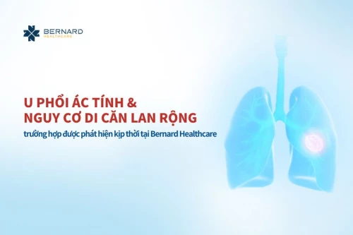 Kịp thời phát hiện u phổi ác tính trước khi di căn lan rộng ở người không triệu chứng hô hấp